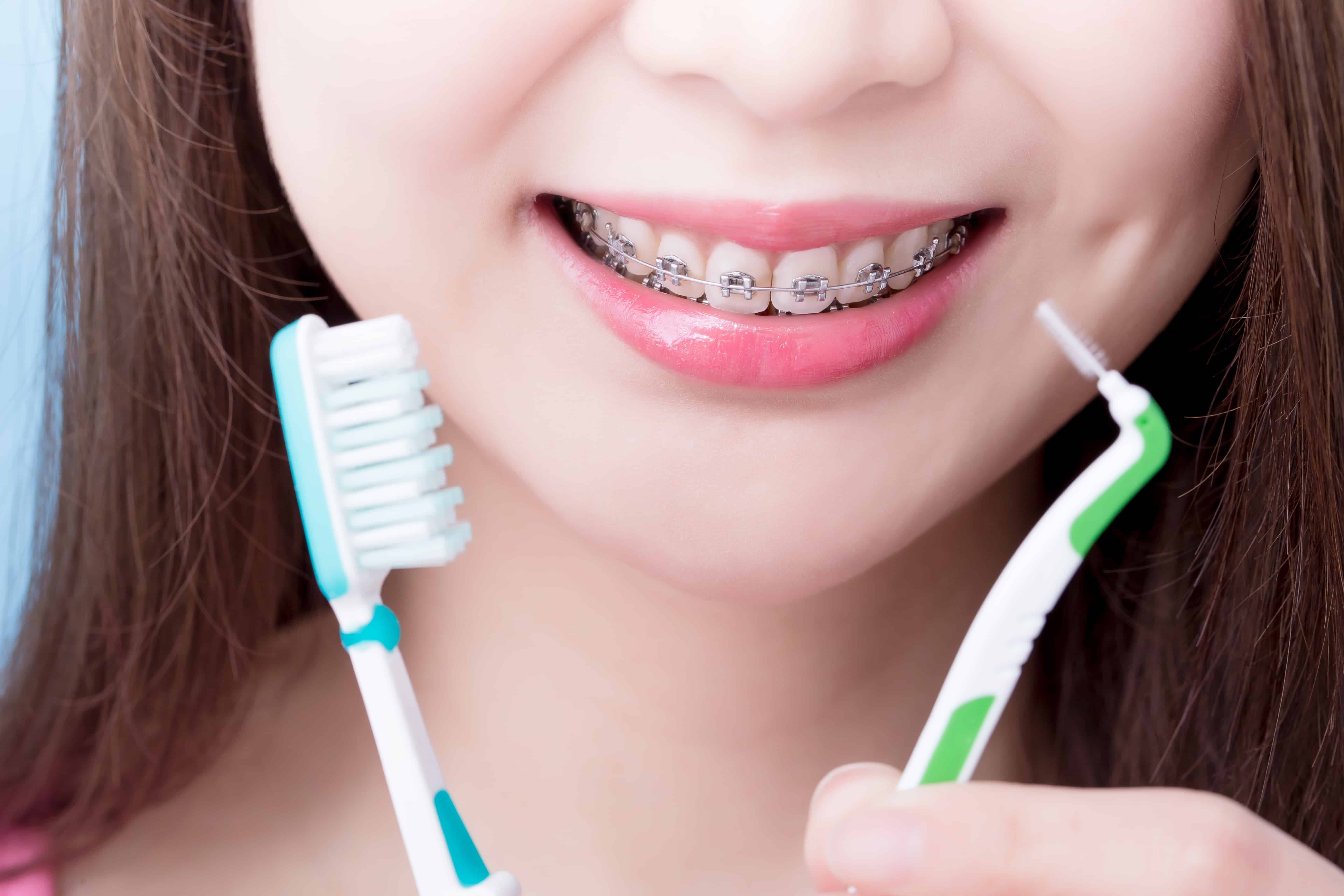 aligners and braces