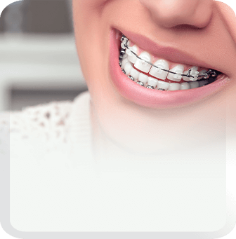 aligners and braces type