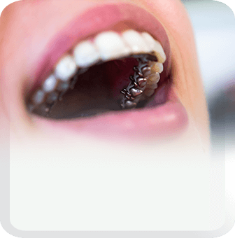 aligners and braces type