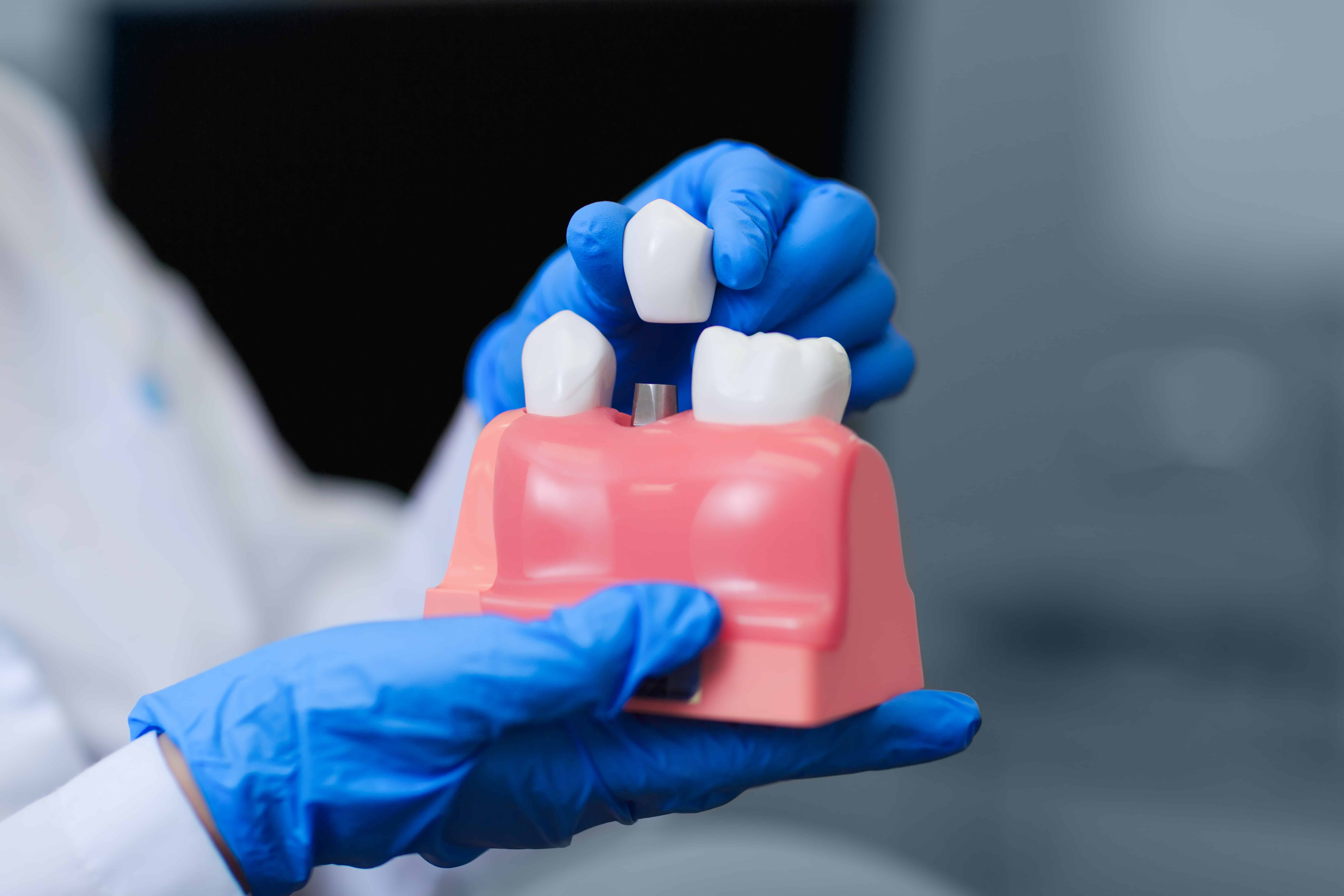 dental crowns