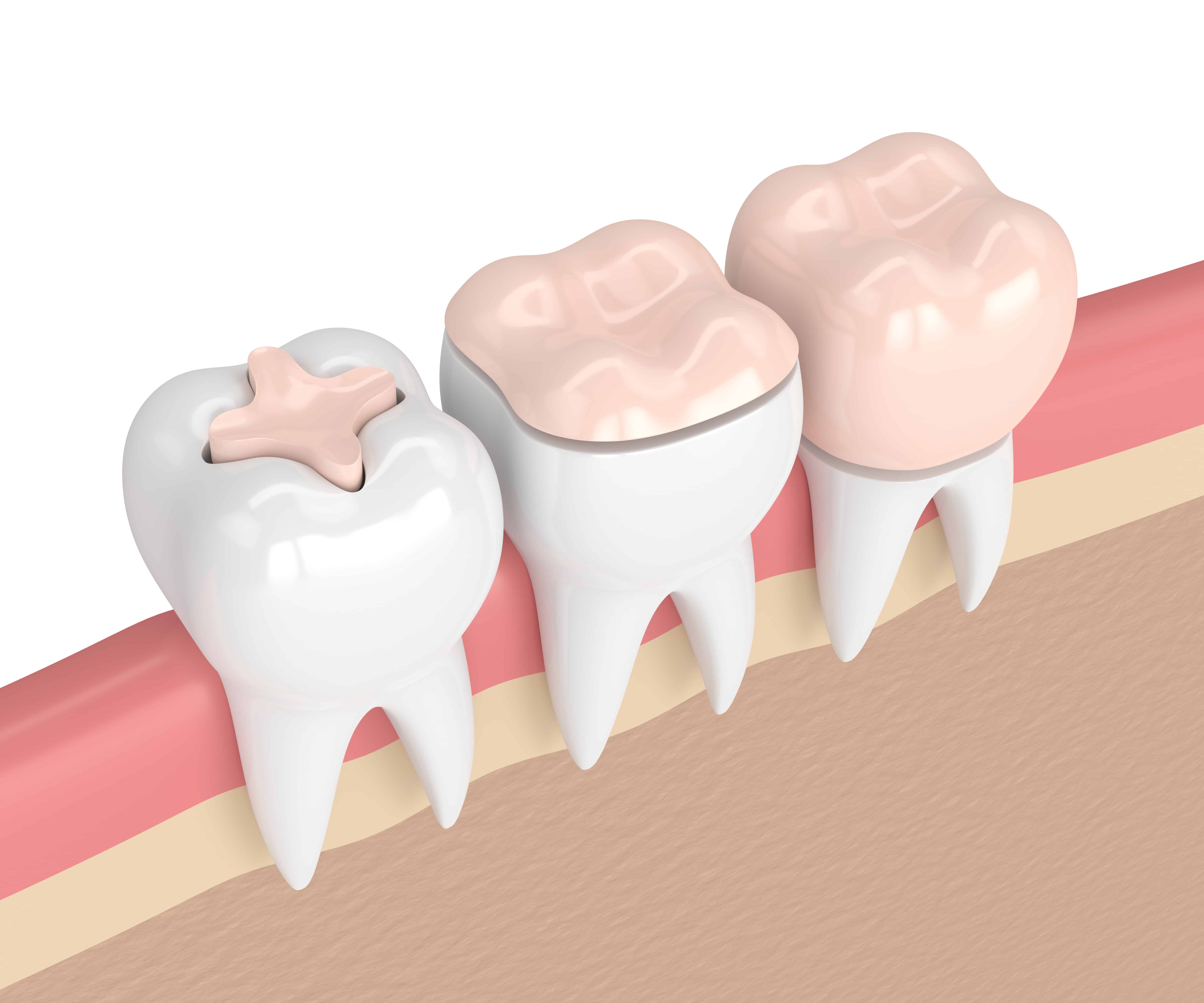 dental crowns