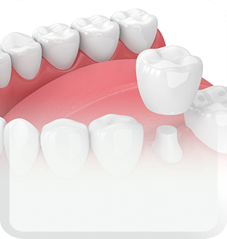 dental crowns type