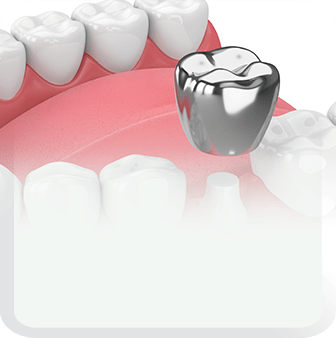 dental crowns type