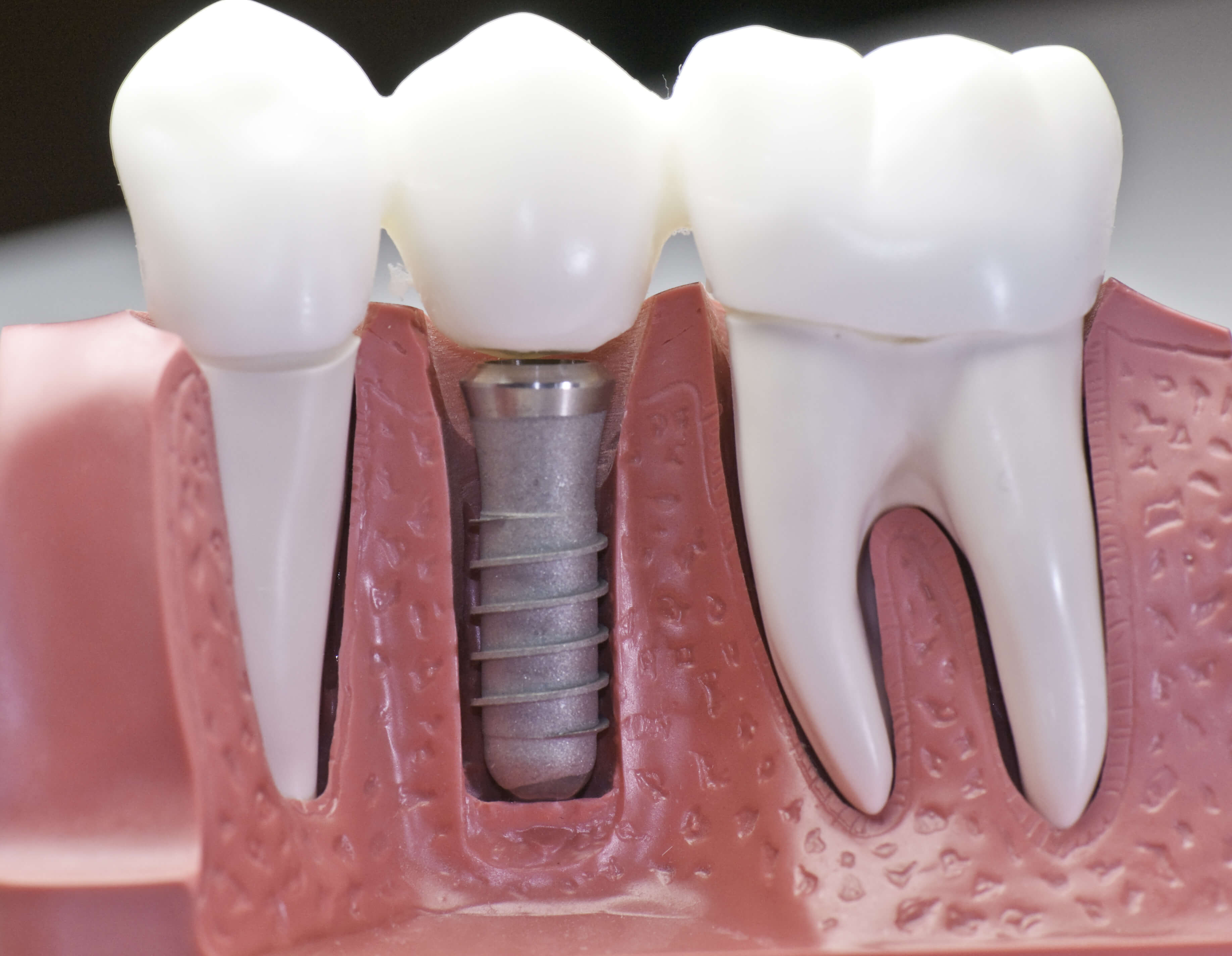 implants