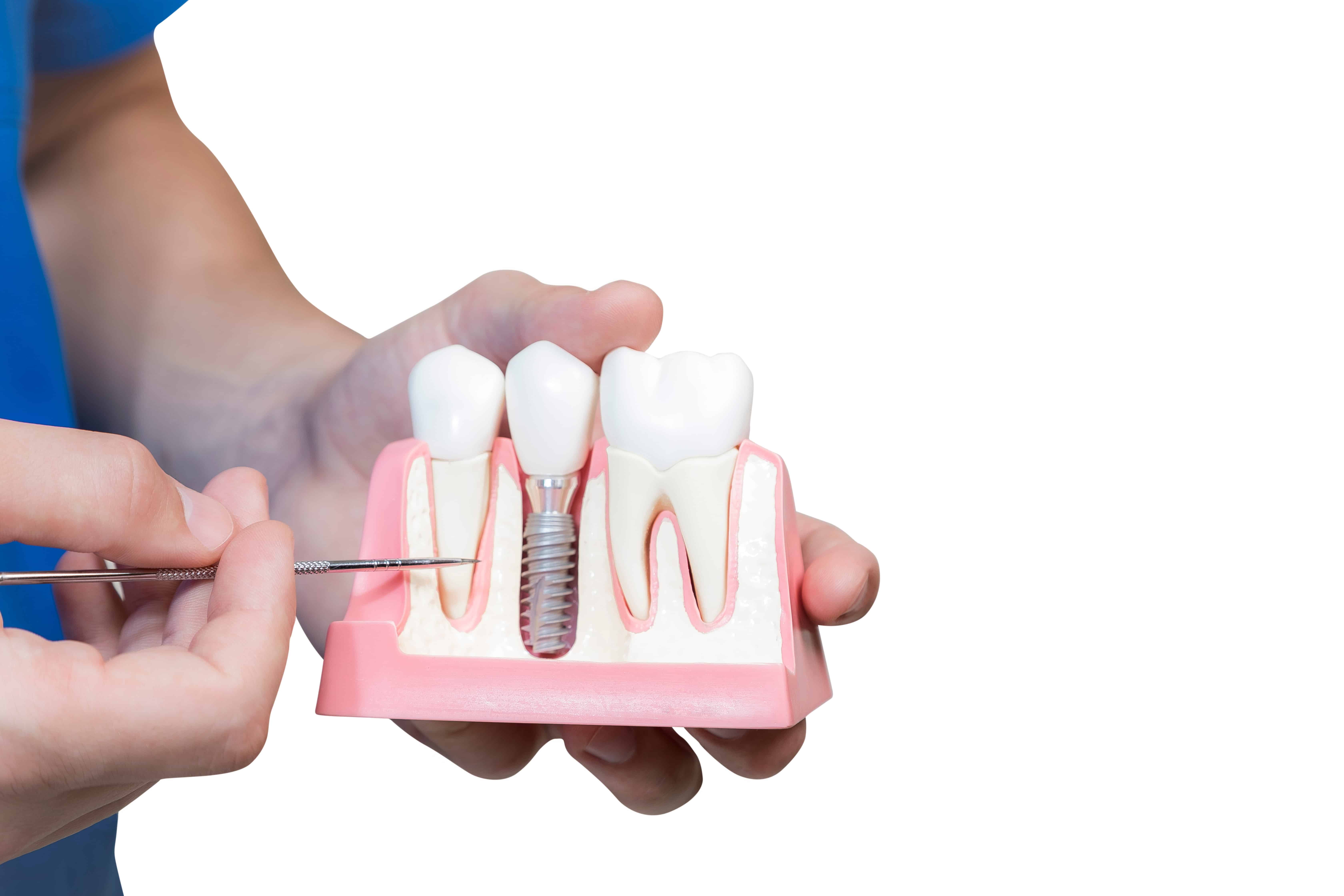 implants