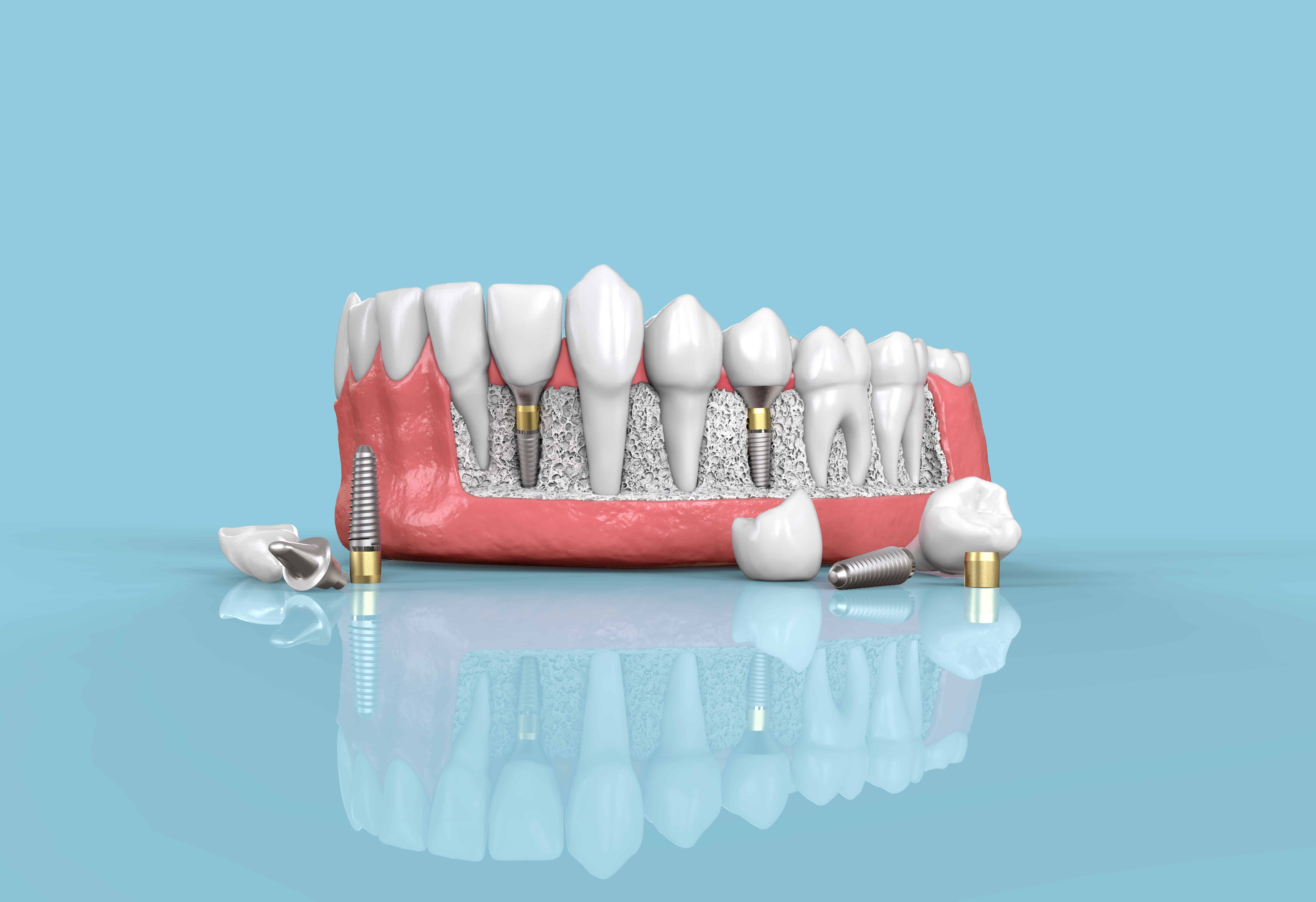 implants