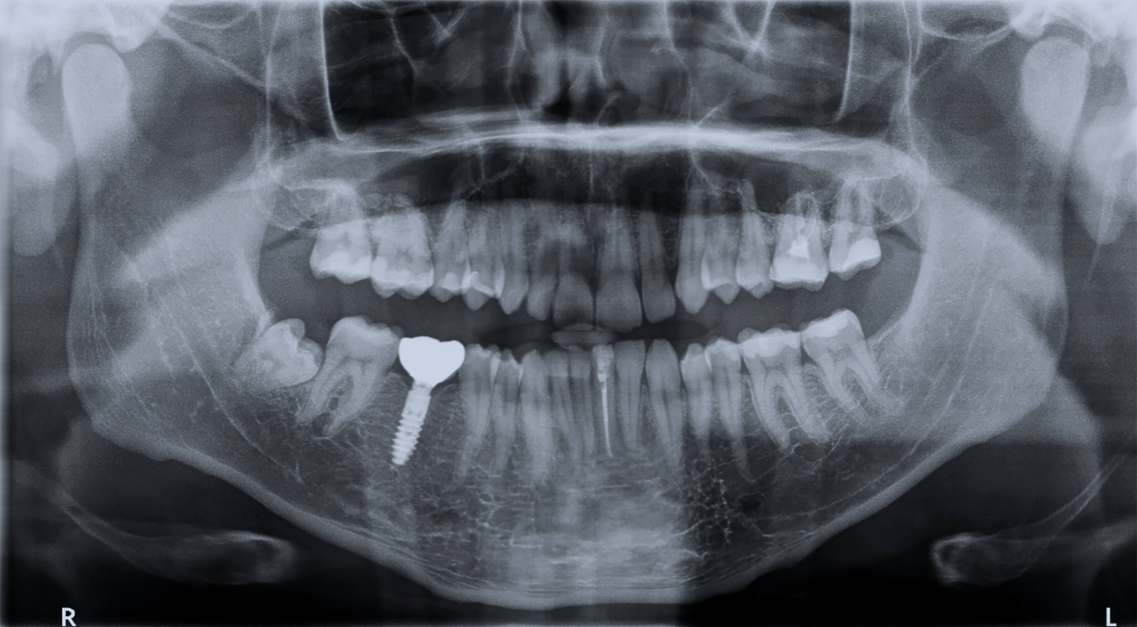 implants