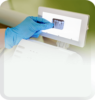 root canal treatment factor