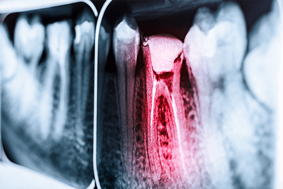 root canal treatment root canal treatment