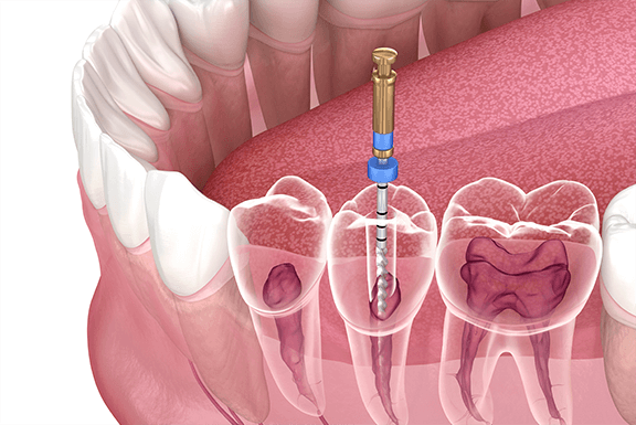 root canal treatment root canal treatment