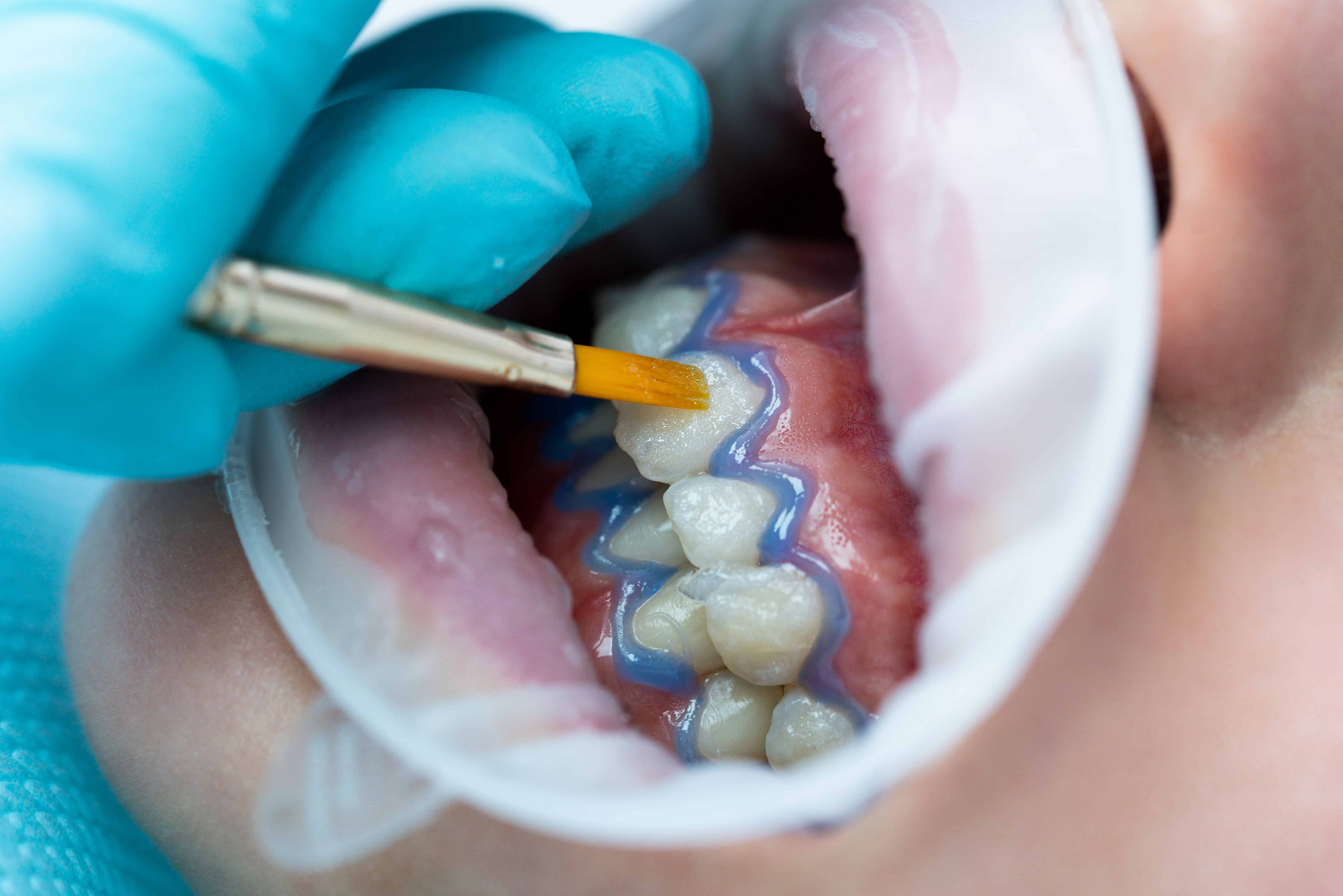 teeth whitening