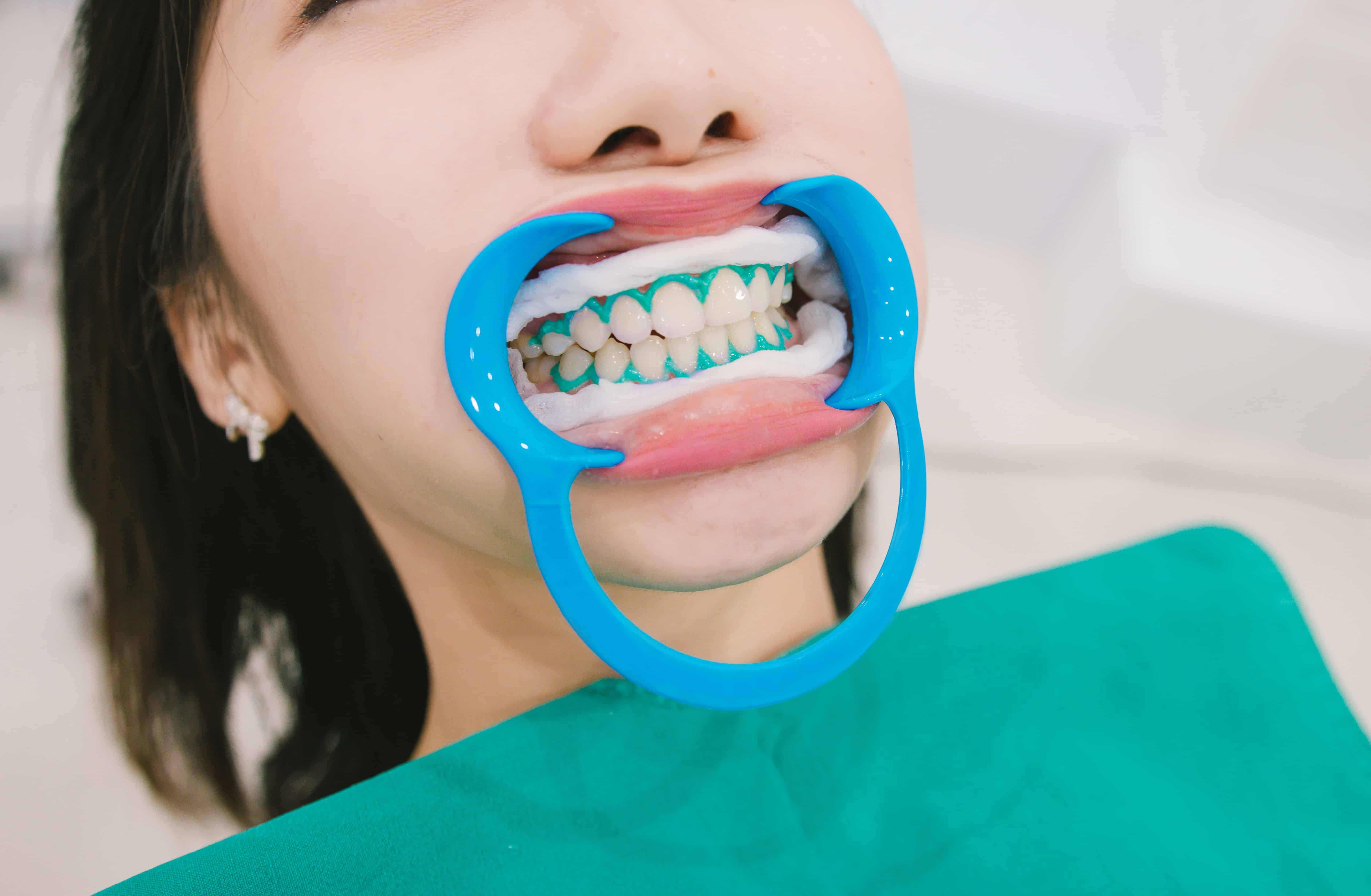 teeth whitening