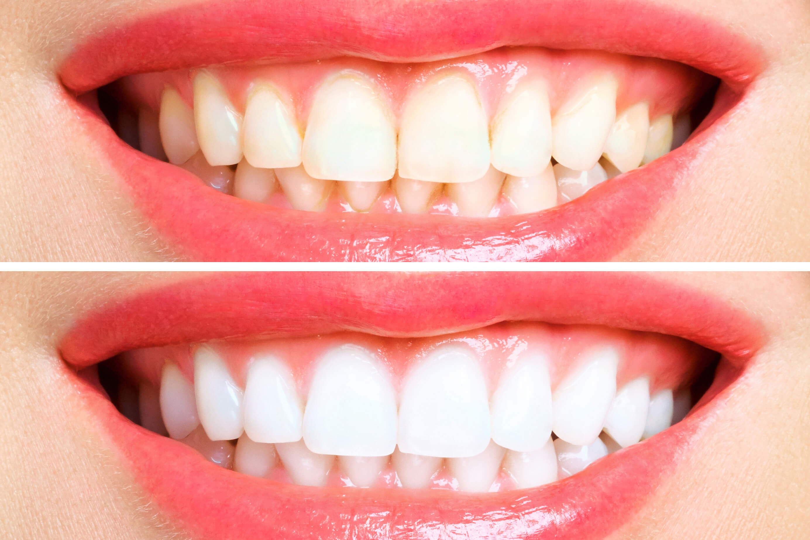 teeth whitening