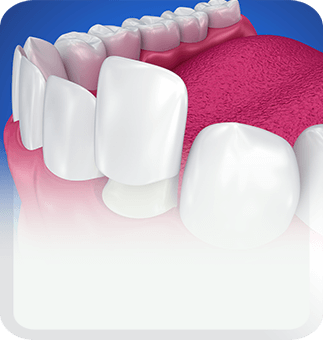 veneer type