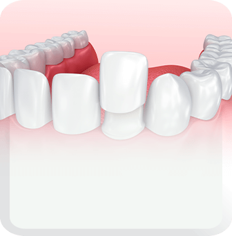 veneer type