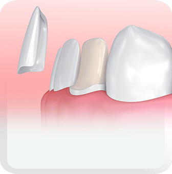 veneer type