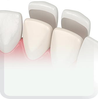 veneer type
