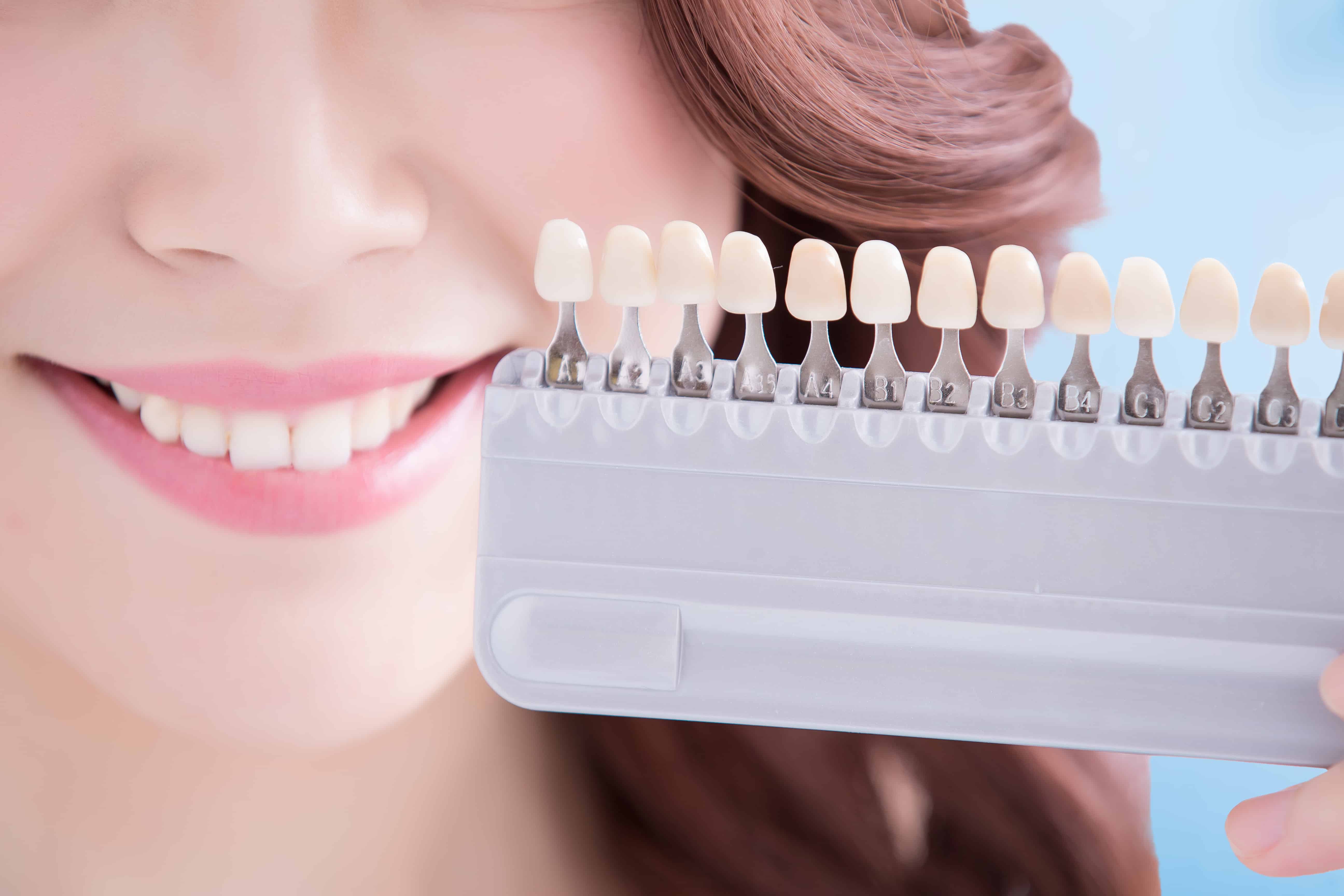 veneers