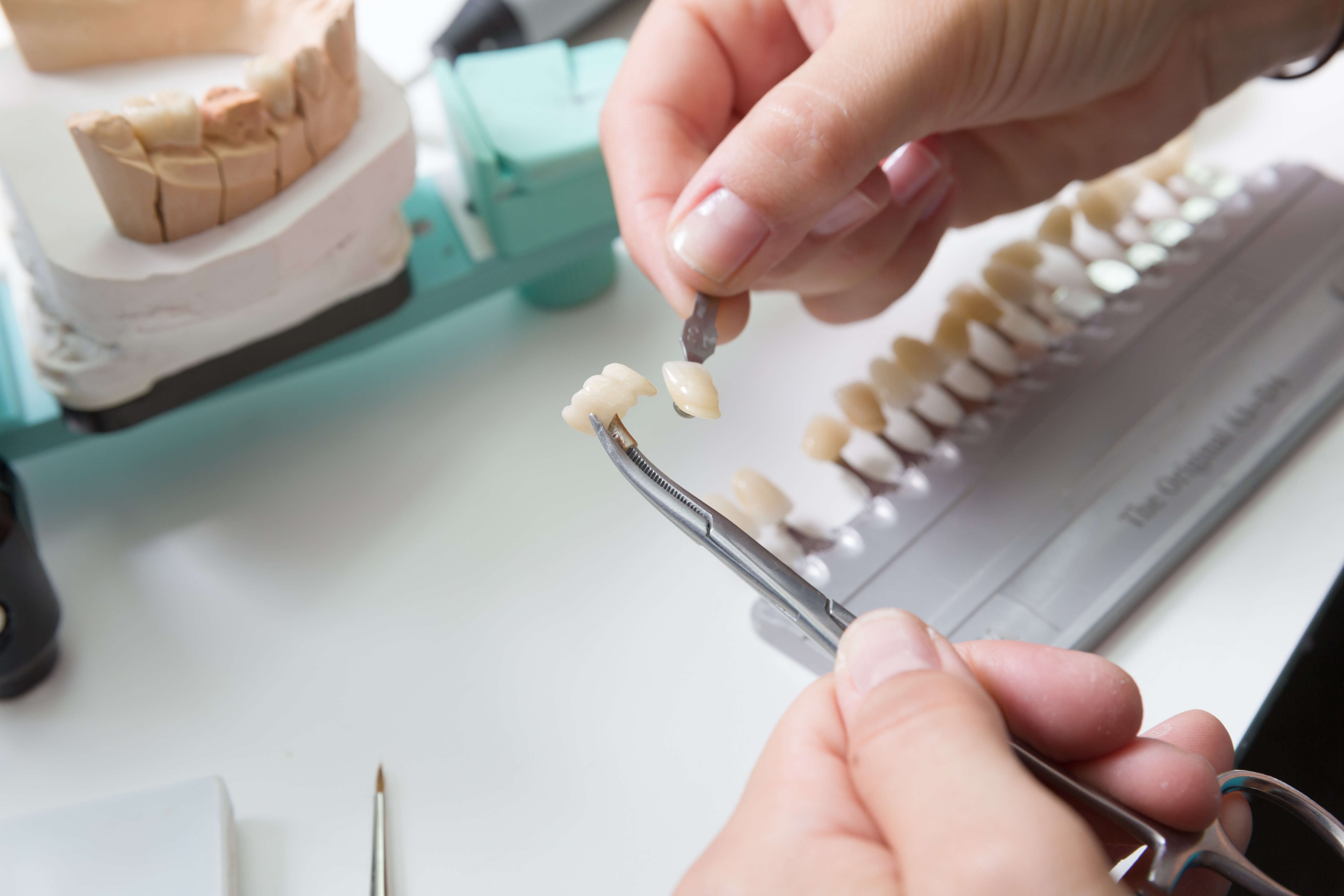 veneers