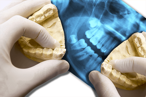 wisdom tooth extraction wisdom tooth extraction