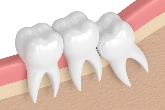 wisdom tooth extraction wisdom tooth extraction