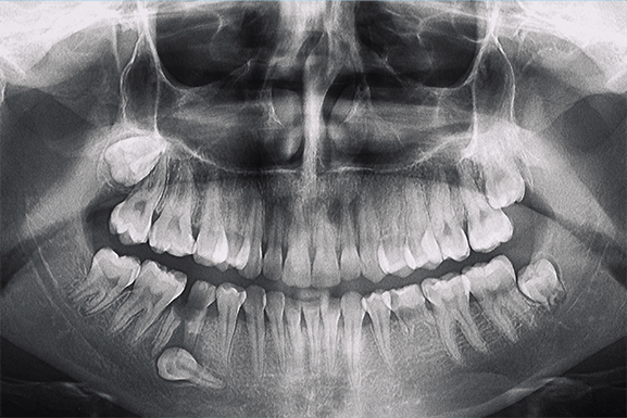 wisdom tooth extraction wisdom tooth extraction